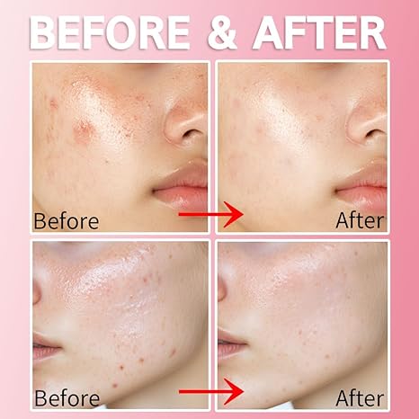 Purederm Blemish Spot Gel – 2% Salicylic Acid, Soothing Acne Treatment, 20ml