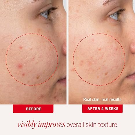 First Aid Beauty Acne Pads – 2% Salicylic Acid, Non-Drying, Sensitive Skin (60ct)