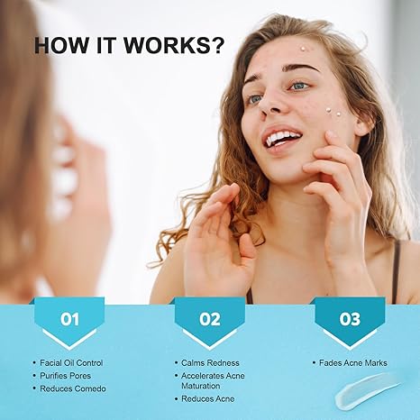 Azelaic Acid Acne Spot Treatment Cream – Cystic, Hormonal, Face & Body, 1.8oz