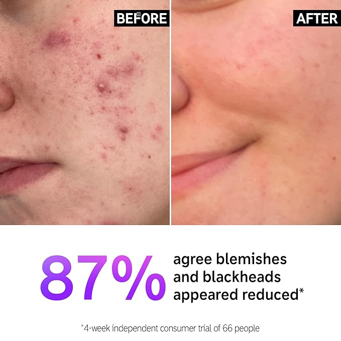 The INKEY List Salicylic Acid Cleanser – Gel Face Wash for Blemishes, Blackheads, Oily Skin & Breakouts – Non-Drying, Fragrance Free, Vegan – 5.0 fl oz