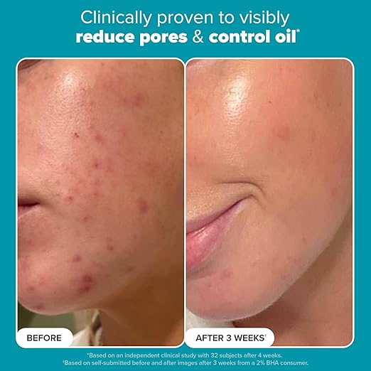 Paula’s Choice 2% BHA Liquid Exfoliant – Salicylic Acid for Pores & Blackheads
