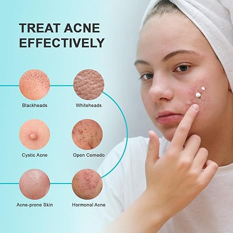 Azelaic Acid Acne Spot Treatment Cream – Cystic, Hormonal, Face & Body, 1.8oz