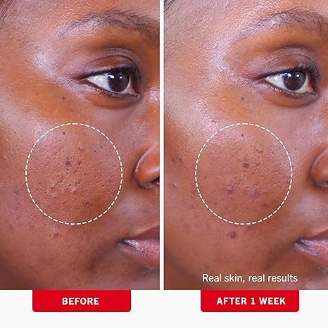 First Aid Beauty Acne Pads – 2% Salicylic Acid, Non-Drying, Sensitive Skin (60ct)